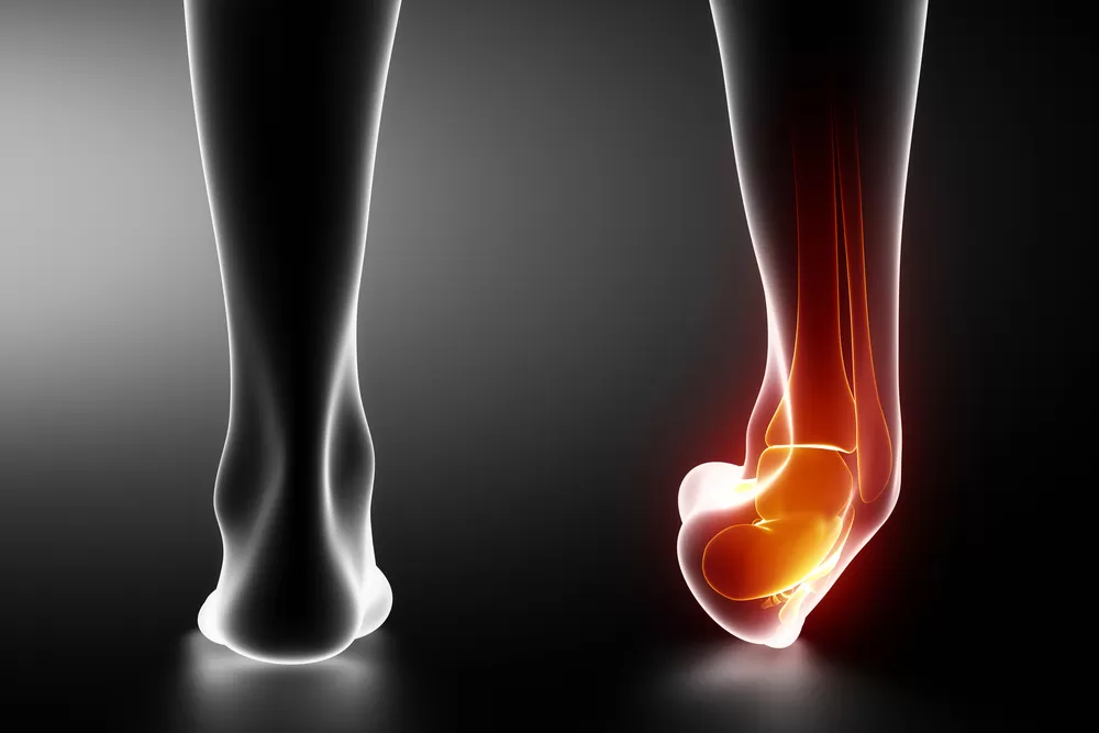 Esguince de tobillo_ lesión fisioterapia y podología Clinica Redi Irún